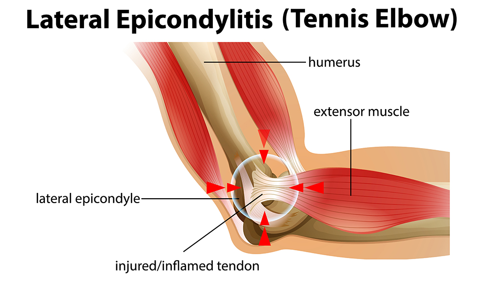 tennis elbow