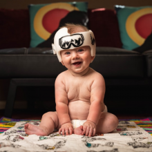 Positional Plagiocephly – misshapen head and flat spots