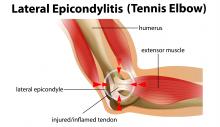 tennis elbow