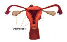 Endometriosis